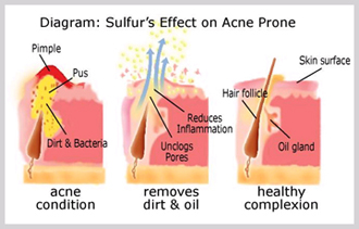 Sulfur soap before clearance and after